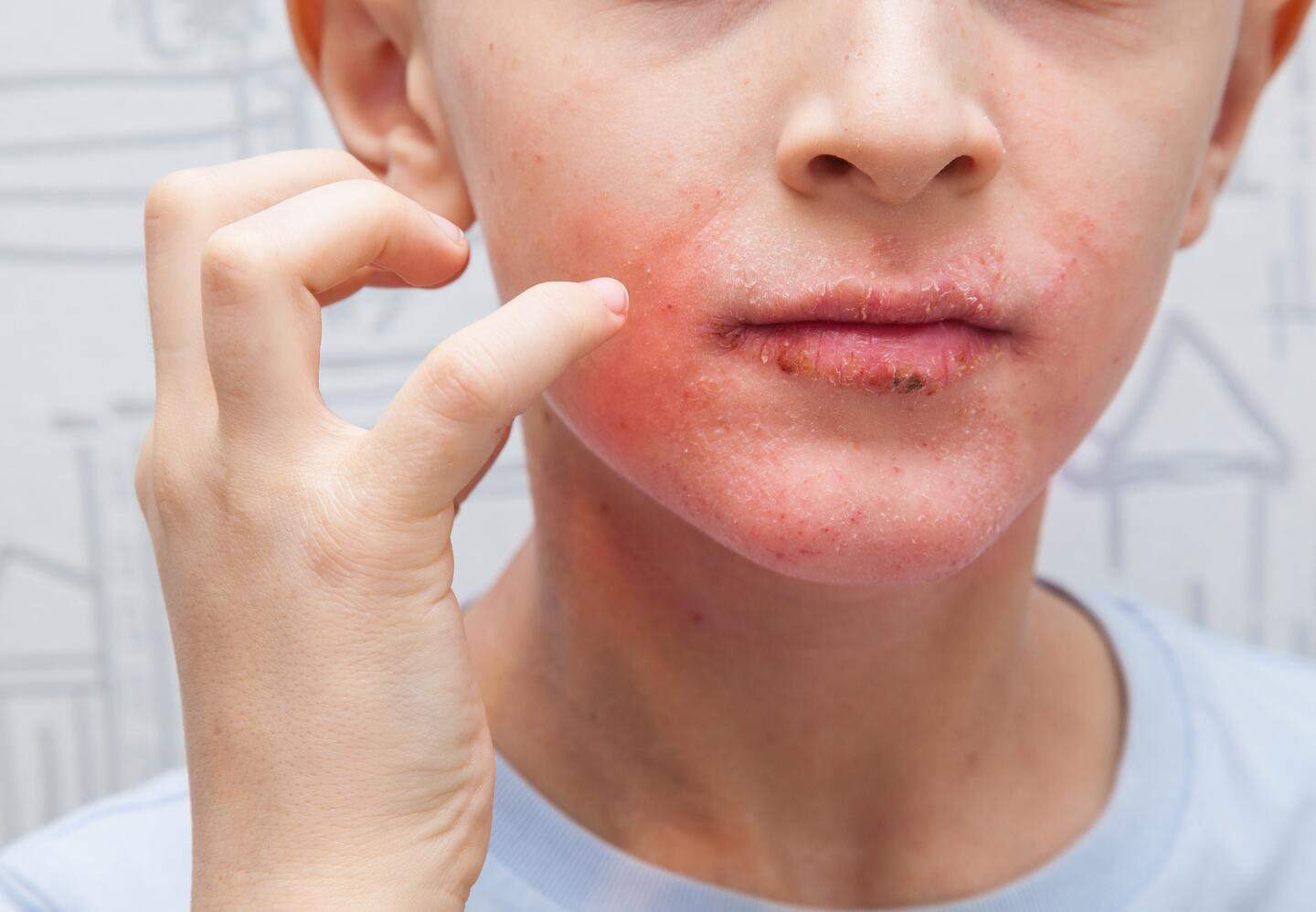 Child with eczema patches on the face